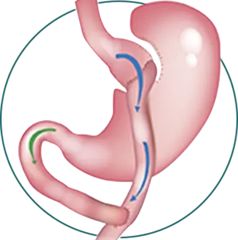 Gastric-Bypass