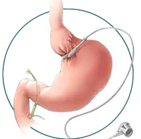 Gastric-Lap-Banding